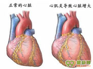 特异性心肌病